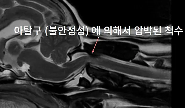 환축추 불안정 (AAI, atlantoaxial instability) — MRI·CT 영상