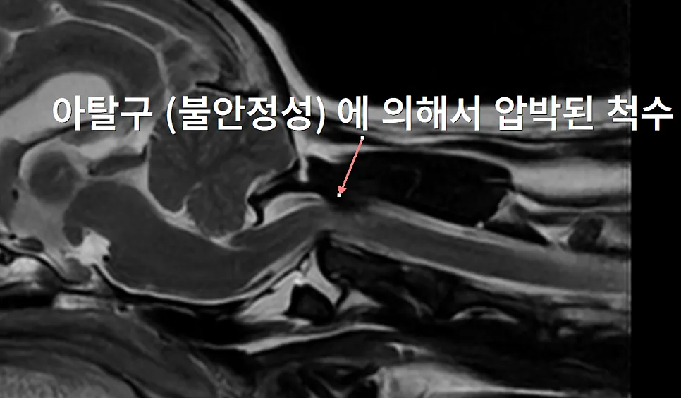 경추 1·2번 사이가 어긋나(아탈구) 눌린 척수 (MRI)