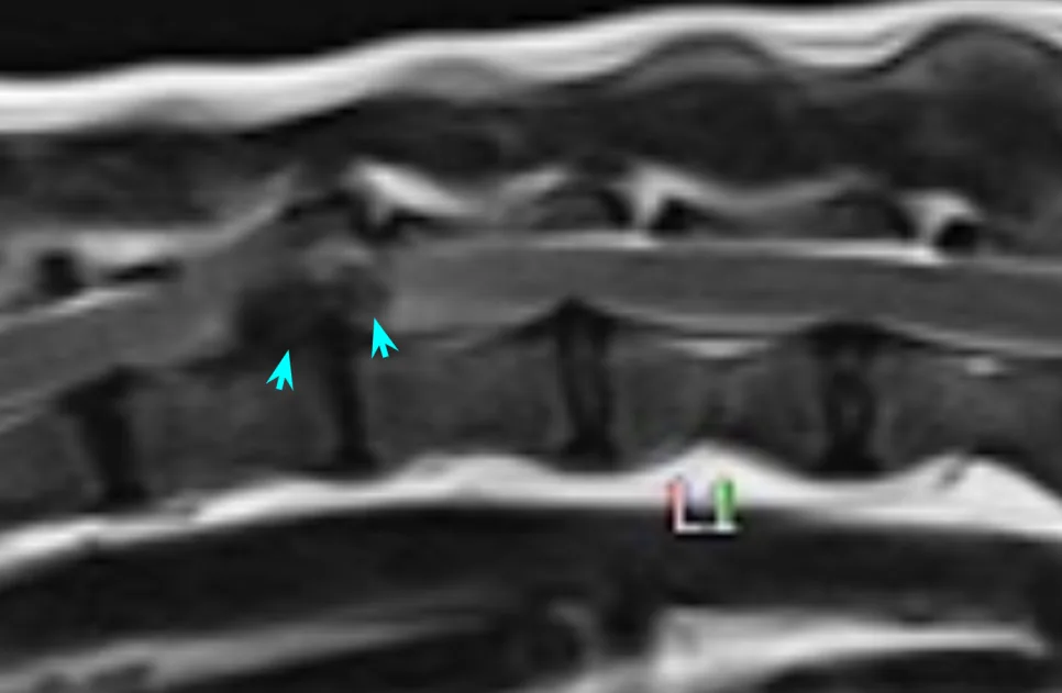 갑자기 튀어나온 디스크(검은색)가 척수를 누르는 추간판 탈출증 (MRI)