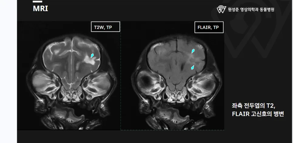 뇌수막염의 전형적인 MRI 소견 — 왼쪽 전두엽의 T2·FLAIR 고신호 병변