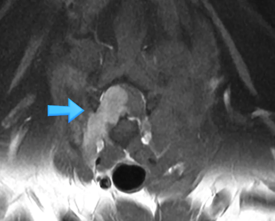 목 신경(C6–7)에서 생겨 척수를 누르는 말초 신경 수초종 (MRI, 화살표)